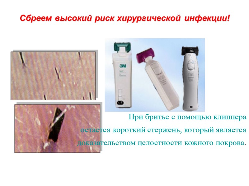 Сбреем высокий риск хирургической инфекции!         